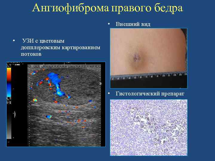 Ангиофиброма правого бедра • Внешний вид • УЗИ с цветовым допплеровским картированием потоков •