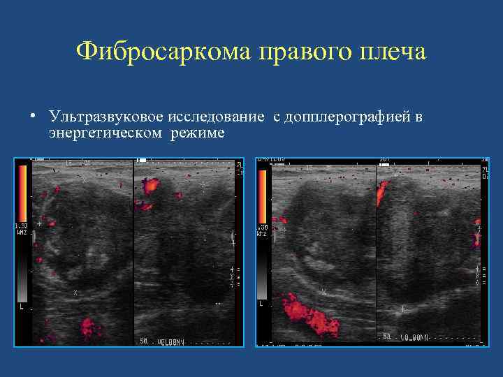 Фибросаркома правого плеча • Ультразвуковое исследование с допплерографией в энергетическом режиме 