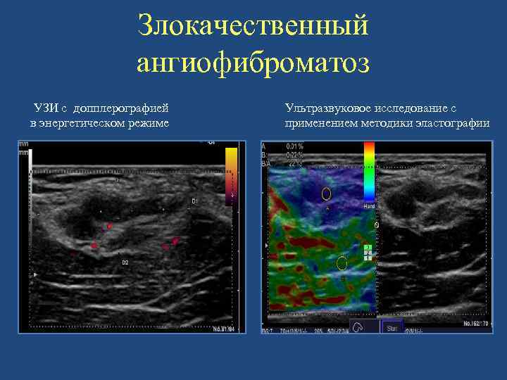 Злокачественный ангиофиброматоз УЗИ с допплерографией в энергетическом режиме Ультразвуковое исследование с применением методики эластографии