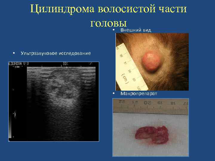 Цилиндрома волосистой части головы вид • Внешний • Ультразвуковое исследование • Макропрепарат 