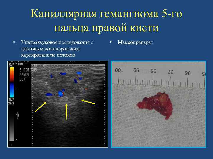Капиллярная гемангиома 5 -го пальца правой кисти • Ультразвуковое исследование с цветовым допплеровским картированием