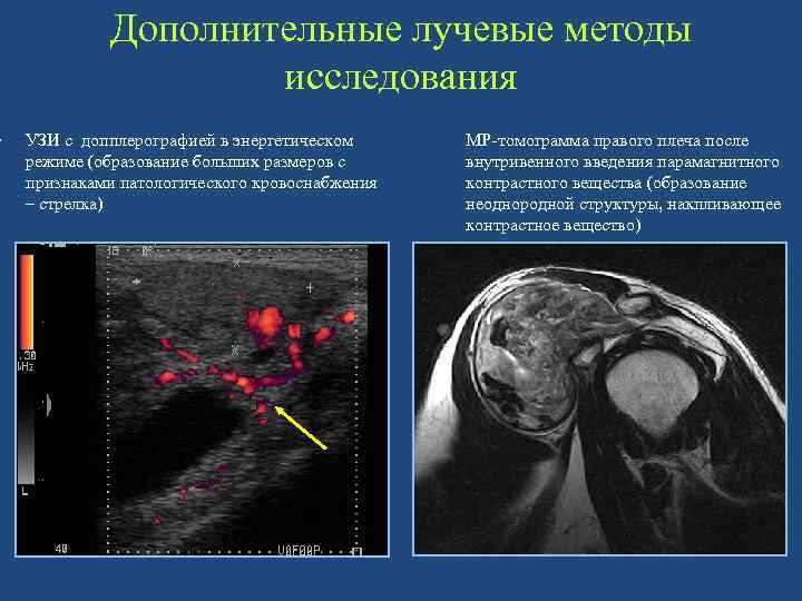  • Дополнительные лучевые методы исследования УЗИ с допплерографией в энергетическом режиме (образование больших