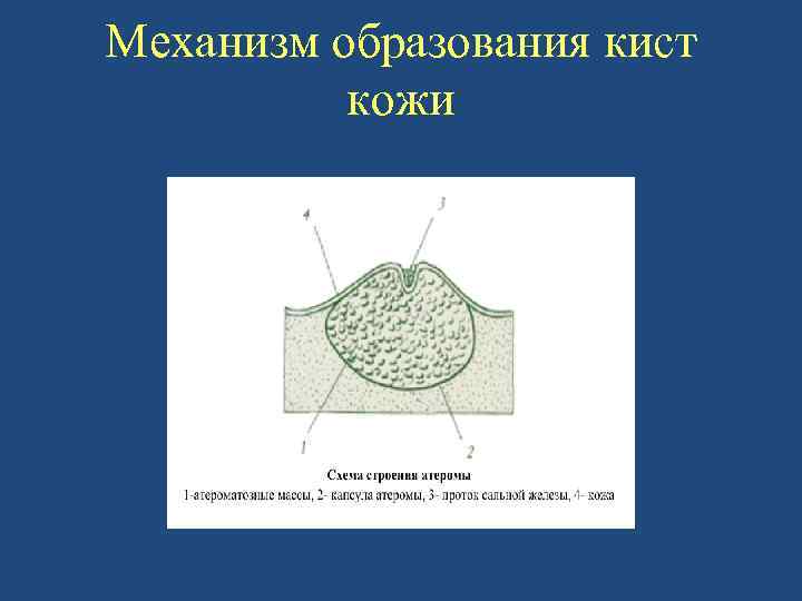 Механизм образования кист кожи 