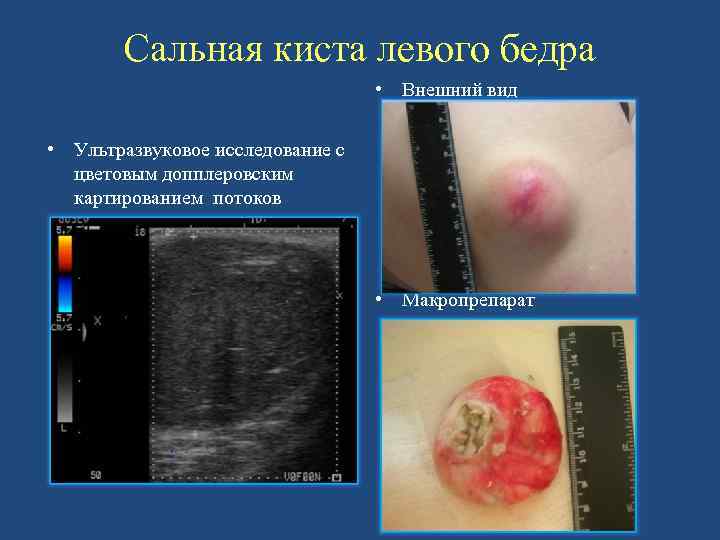 Сальная киста левого бедра • Внешний вид • Ультразвуковое исследование с цветовым допплеровским картированием