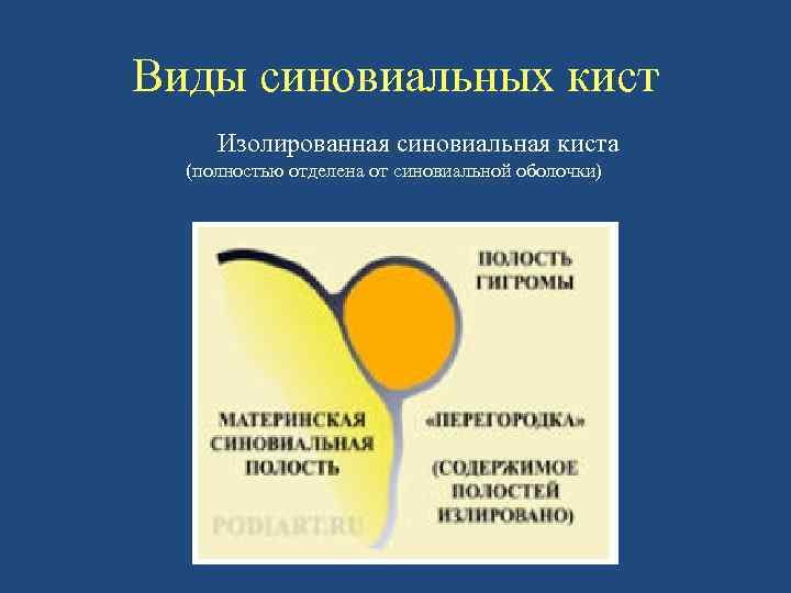 Виды синовиальных кист Изолированная синовиальная киста (полностью отделена от синовиальной оболочки) 