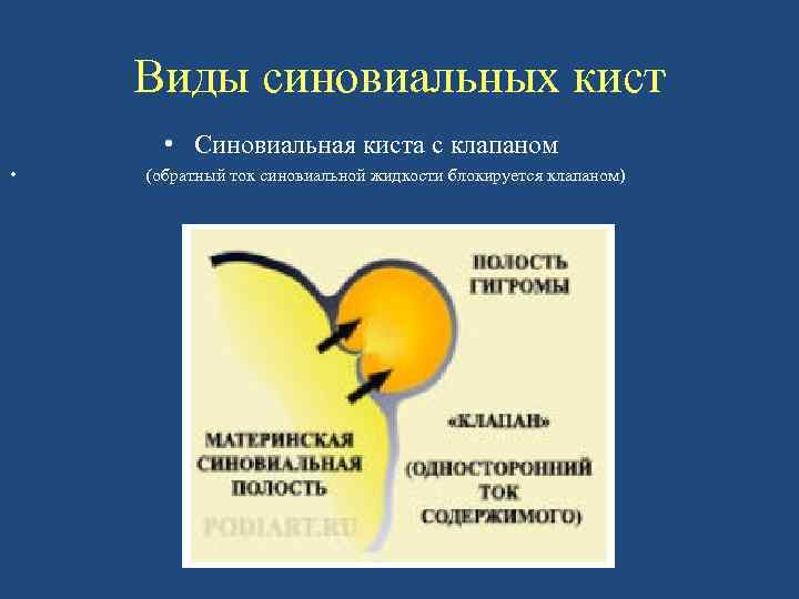 Виды синовиальных кист • Синовиальная киста с клапаном • (обратный ток синовиальной жидкости блокируется