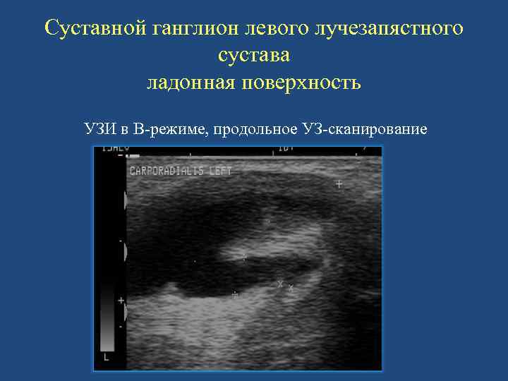 Суставной ганглион левого лучезапястного сустава ладонная поверхность УЗИ в В-режиме, продольное УЗ-сканирование 