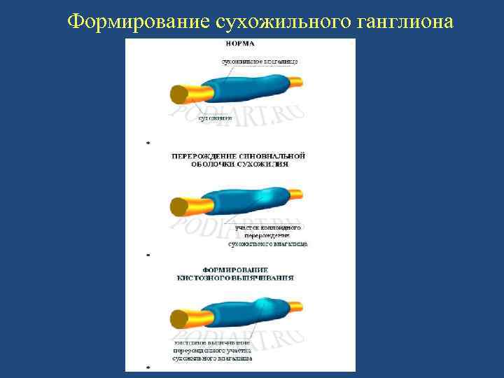 Формирование сухожильного ганглиона 