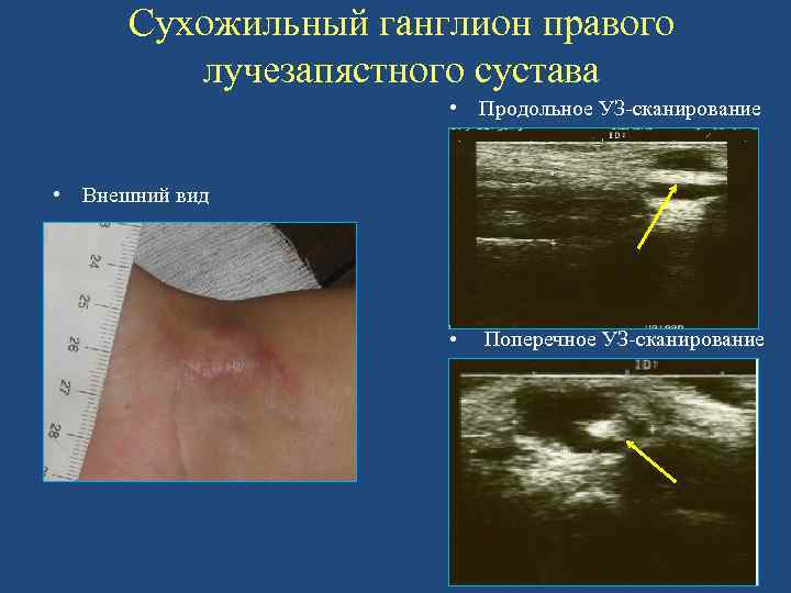 Сухожильный ганглион правого лучезапястного сустава • Продольное УЗ-сканирование • Внешний вид • Поперечное УЗ-сканирование