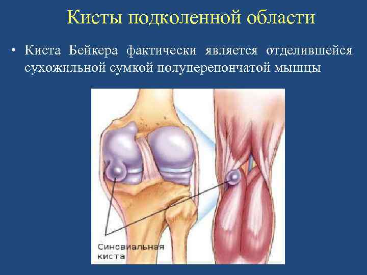 Кисты подколенной области • Киста Бейкера фактически является отделившейся сухожильной сумкой полуперепончатой мышцы 