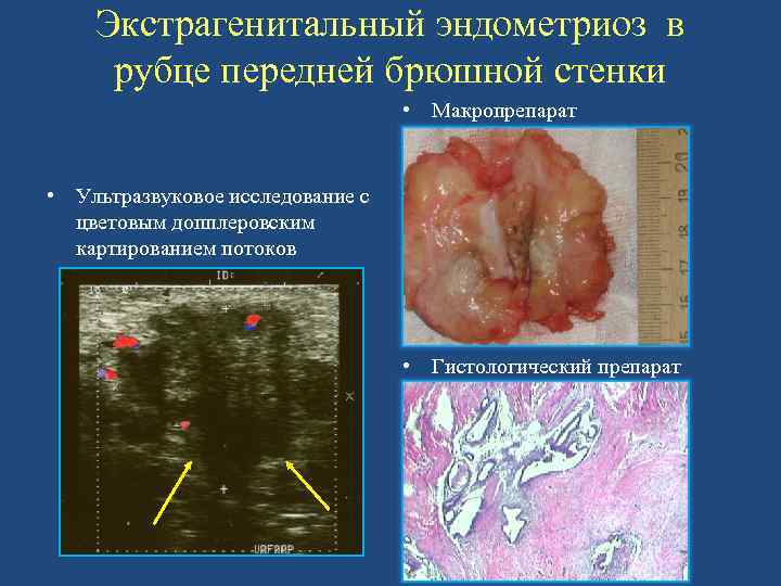 Экстрагенитальный эндометриоз в рубце передней брюшной стенки • Макропрепарат • Ультразвуковое исследование с цветовым