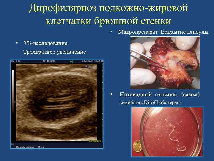 Дирофиляриоз подкожно-жировой клетчатки брюшной стенки • Макропрепарат Вскрытие капсулы • УЗ-исследование Трехкратное увеличение •