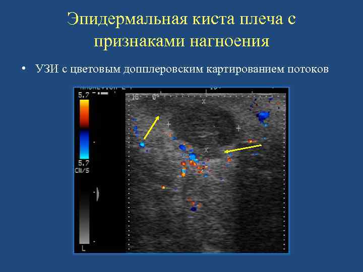 Эпидермальная киста плеча с признаками нагноения • УЗИ с цветовым допплеровским картированием потоков 