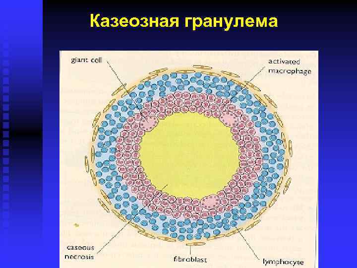 Казеозная гранулема 