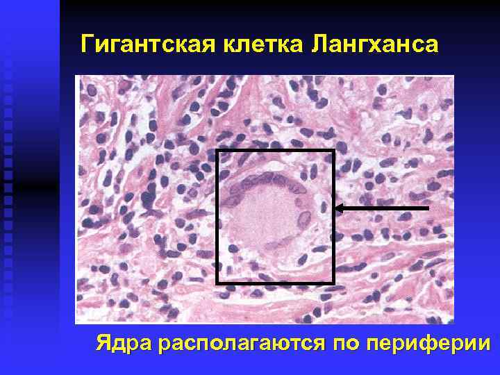 Гигантская клетка Лангханса Ядра располагаются по периферии 