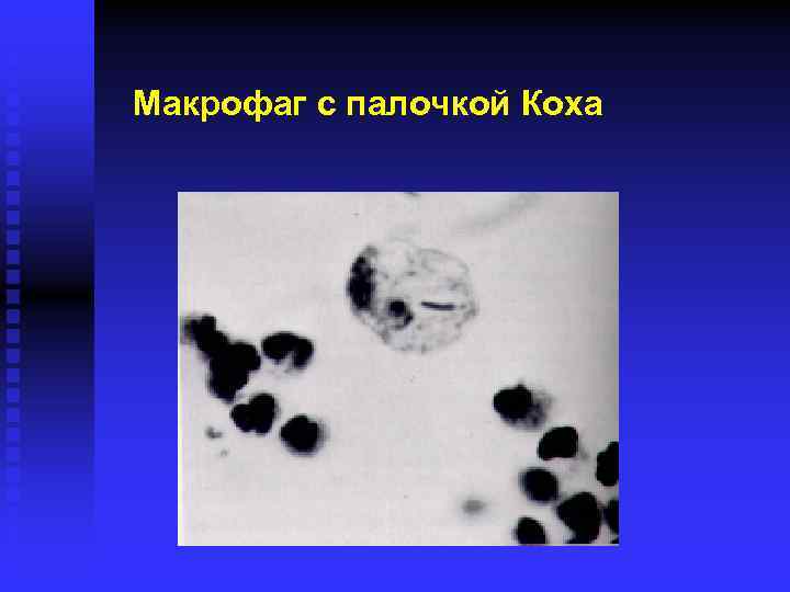 Макрофаг с палочкой Коха 