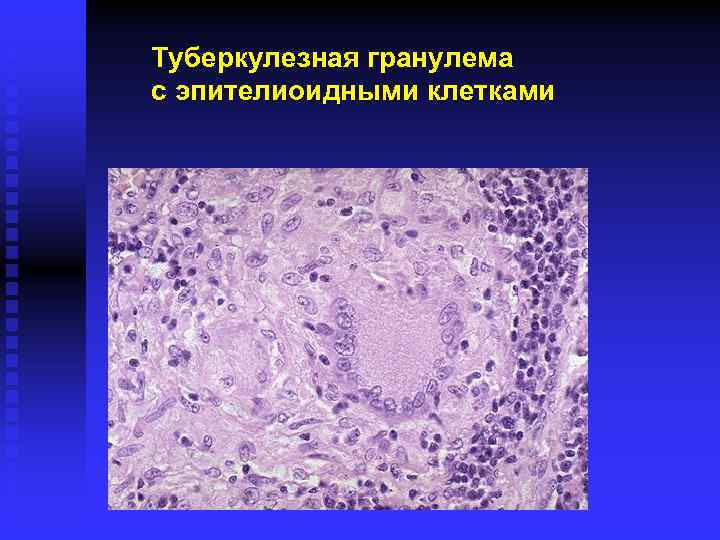 Туберкулезная гранулема с эпителиоидными клетками 