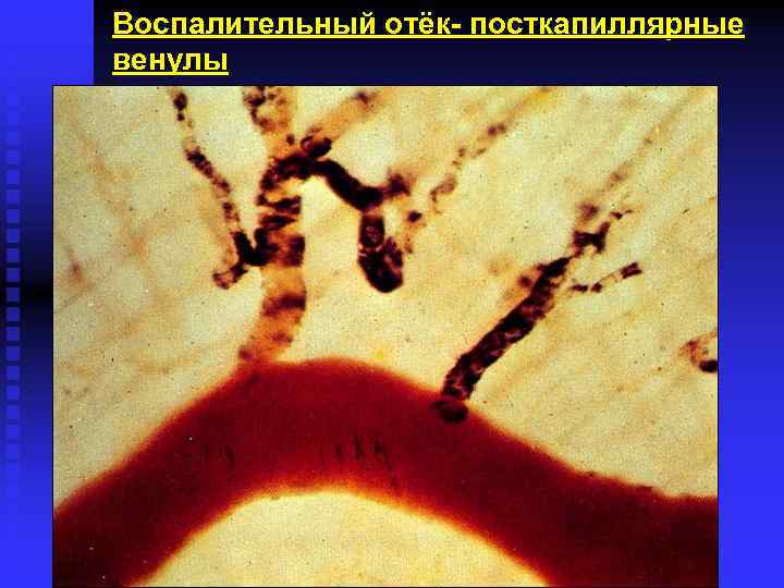 Воспалительный отёк- посткапиллярные венулы 