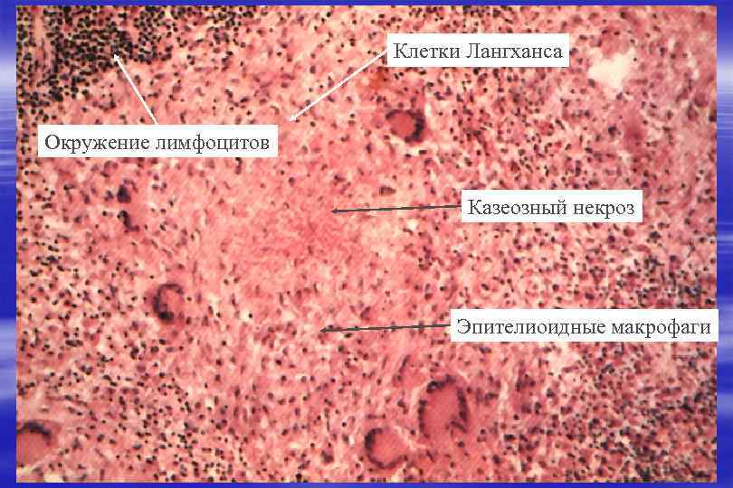 Клетки Лангханса Granuloma Окружение лимфоцитов Казеозный некроз Эпителиоидные макрофаги 