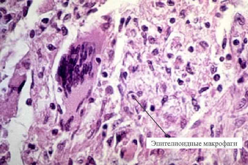 Granuloma with GC Эпителиоидные макрофаги 