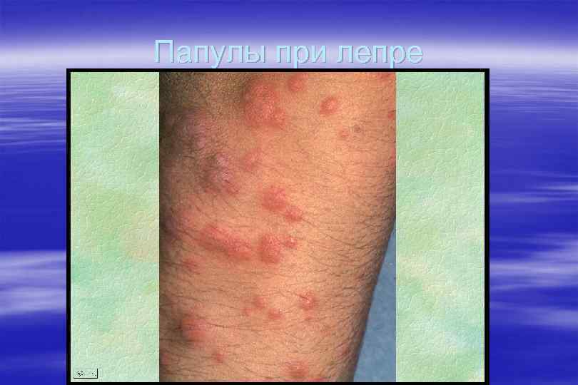 Папулы при лепре 