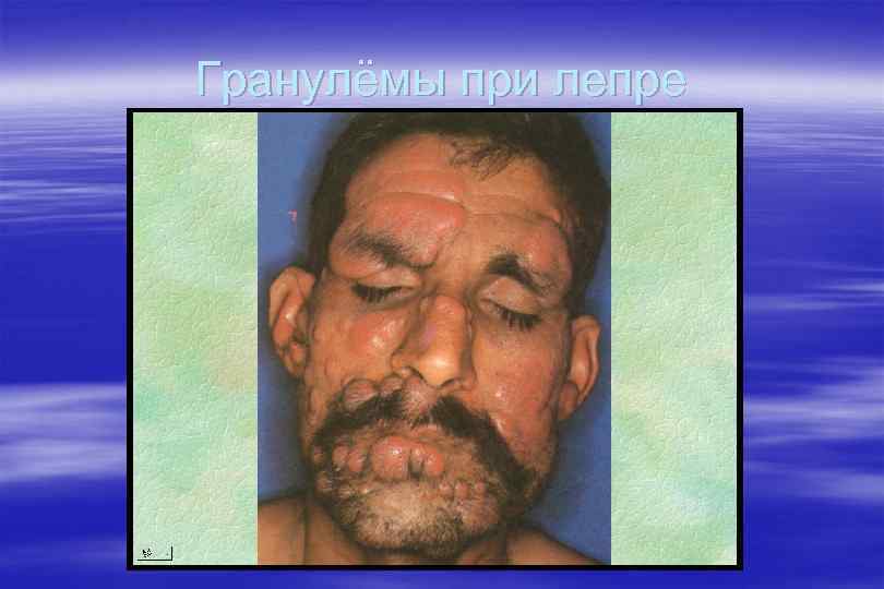 Гранулёмы при лепре 