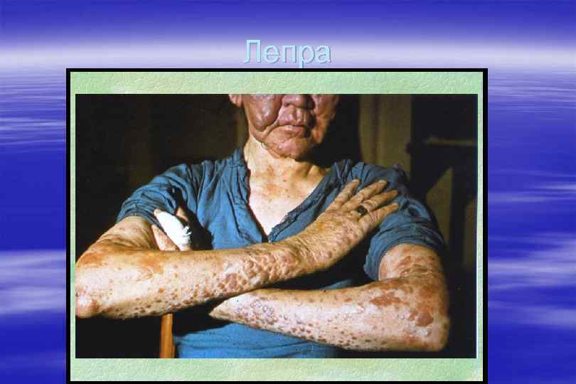 Лепра 