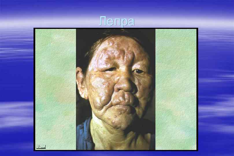 Лепра 