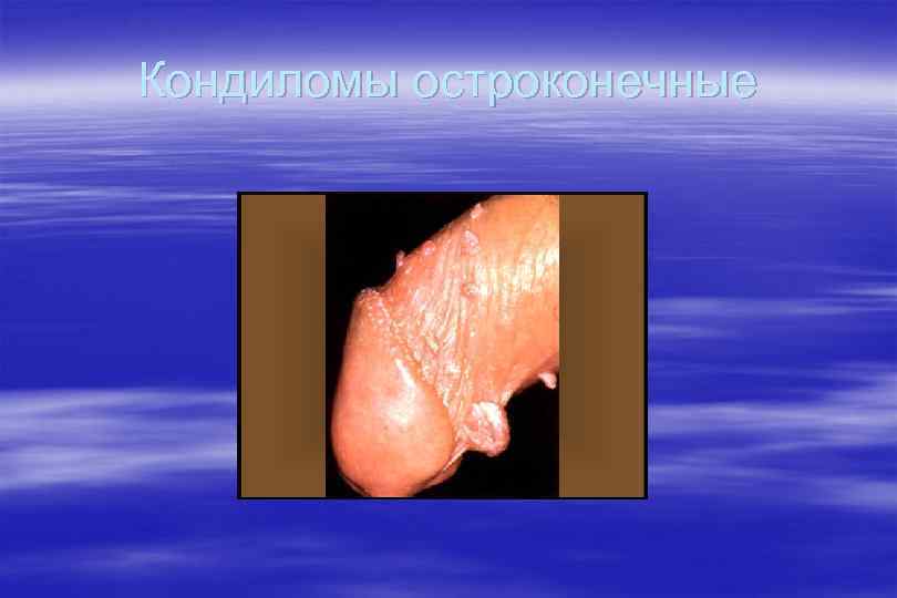 Кондиломы остроконечные 