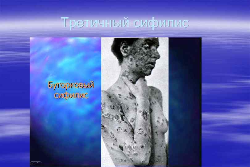 Третичный сифилис 