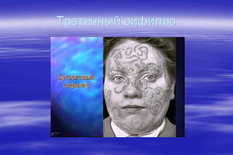 Третичный сифилис 