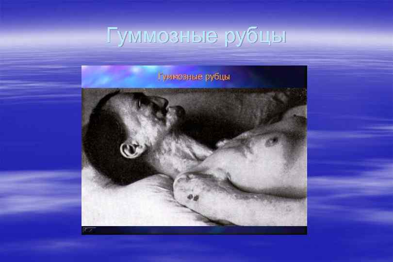 Гуммозные рубцы 