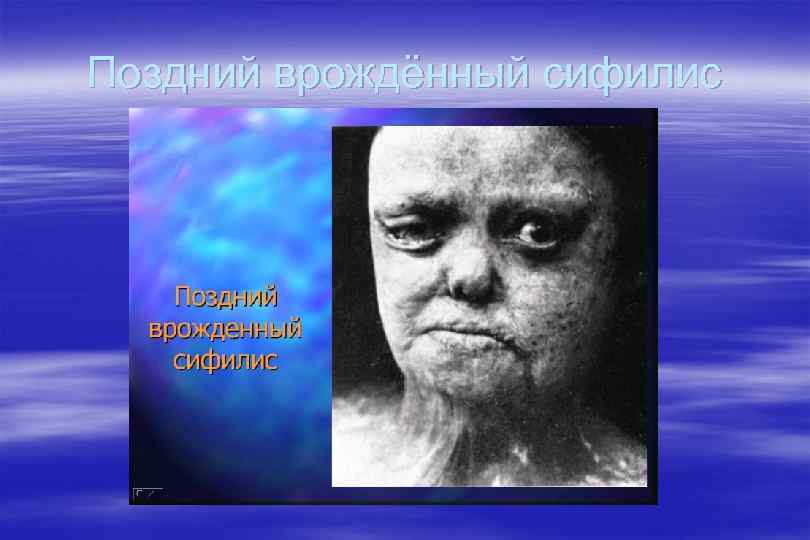 Поздний врождённый сифилис 