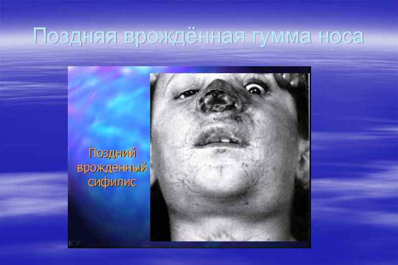 Поздняя врождённая гумма носа 