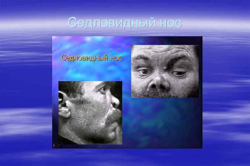 Седловидный нос 