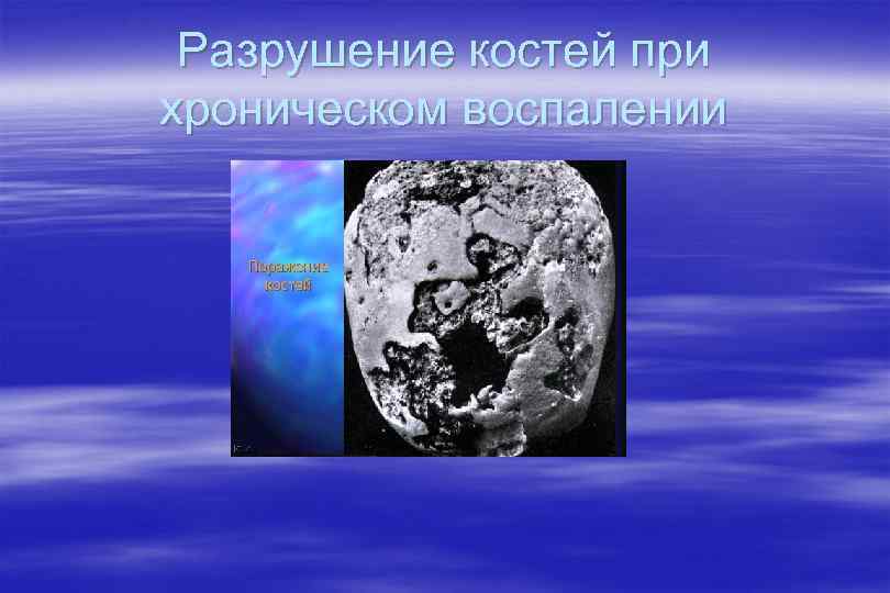 Разрушение костей при хроническом воспалении 