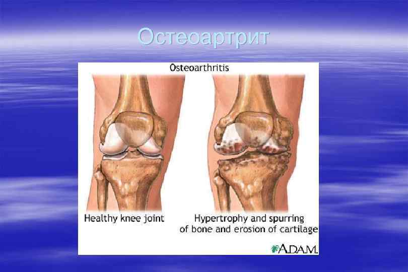 Остеоартрит 