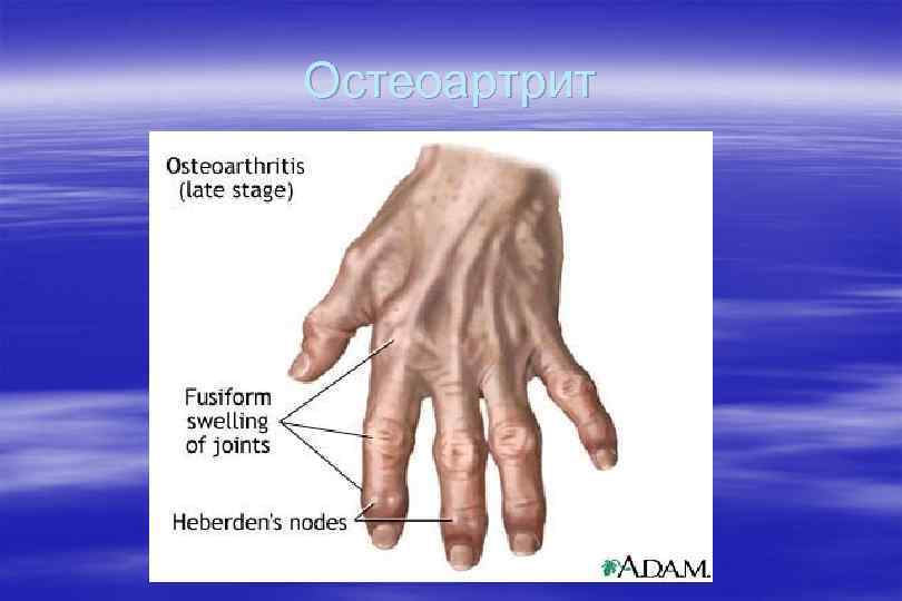 Остеоартрит 