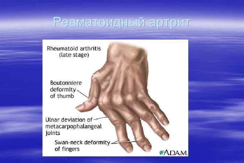 Ревматоидный артрит 