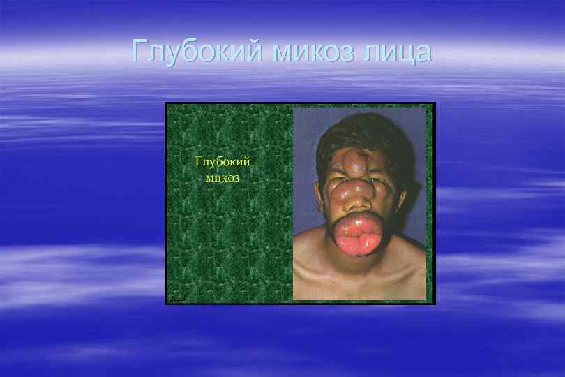 Глубокий микоз лица 
