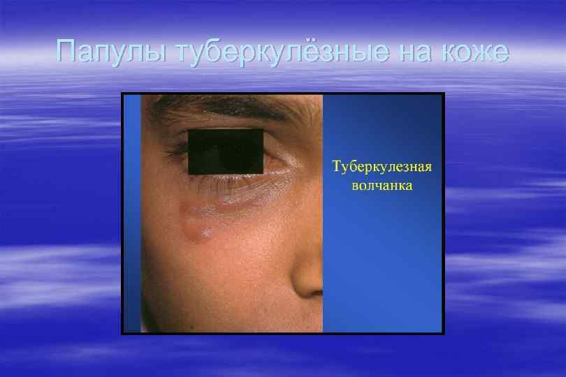 Папулы туберкулёзные на коже 