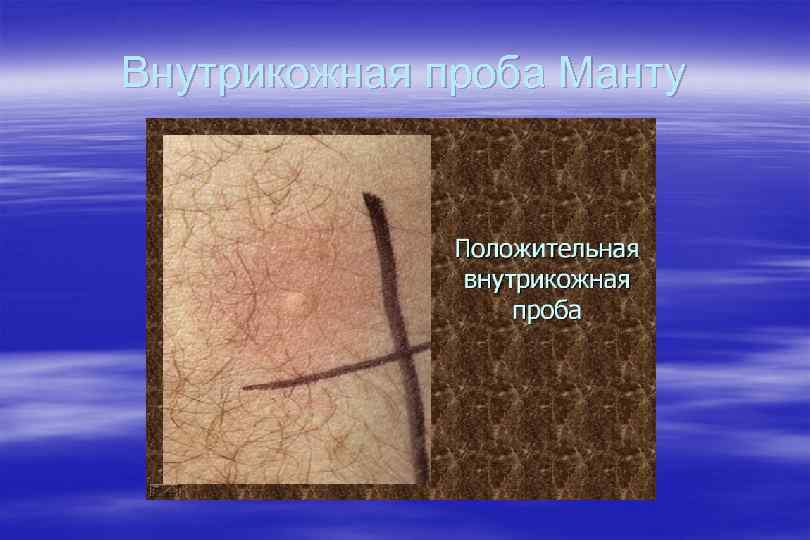 Внутрикожная проба Манту 