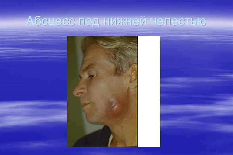 Абсцесс под нижней челестью 