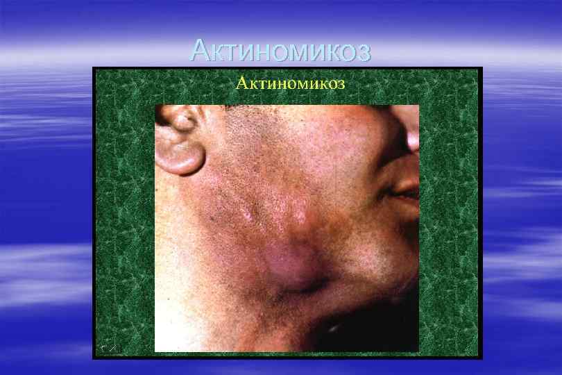 Актиномикоз 