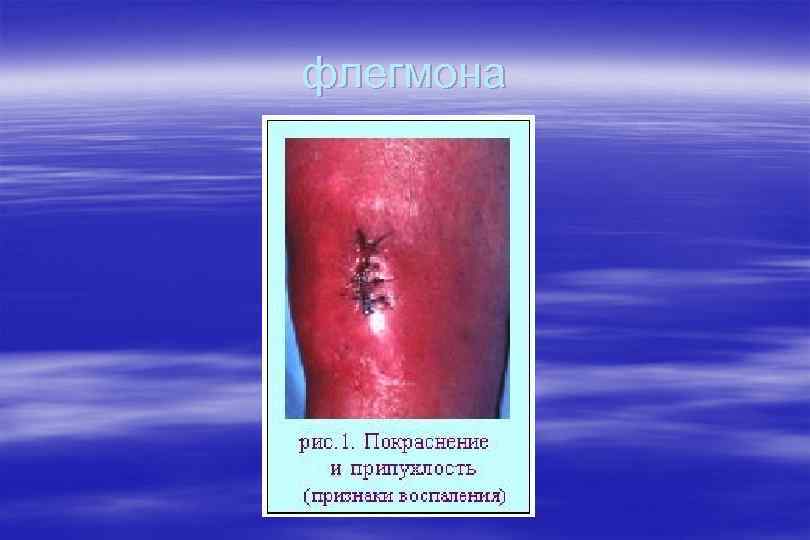флегмона 