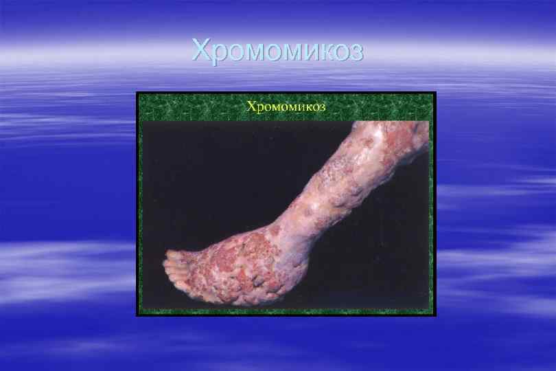 Хромомикоз 