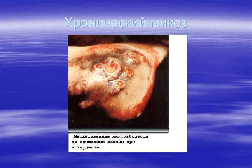 Хронический микоз 