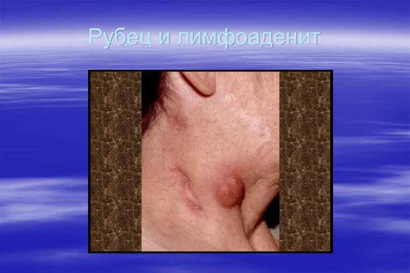 Рубец и лимфоаденит 