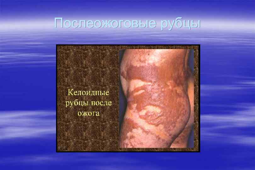 Послеожоговые рубцы 