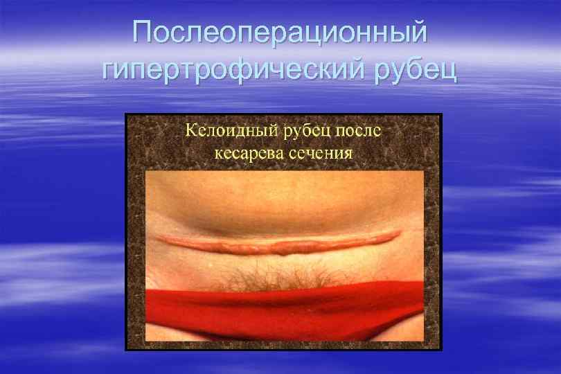 Послеоперационный гипертрофический рубец 